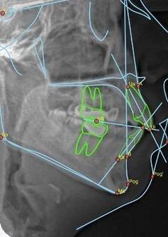 AI cephalometric tracing with landmarks plotted on a ceph