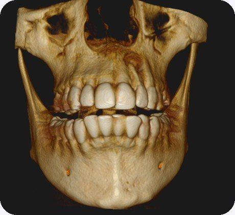 3D CBCT rendering of the upper and lower jaws