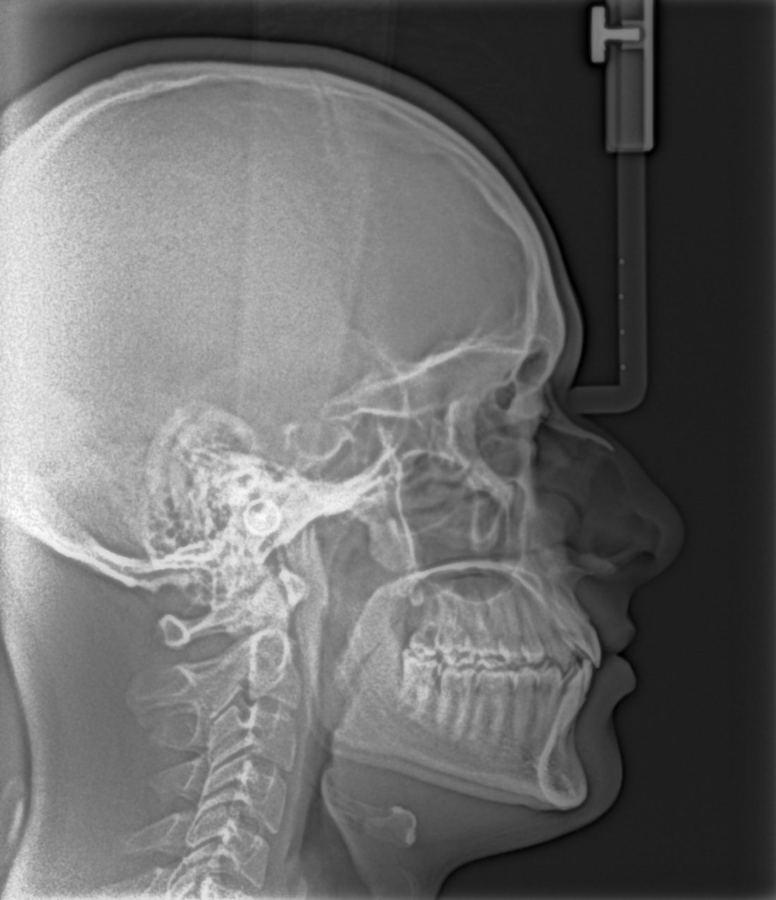 Lateral cephalometric X-ray of the skull and jaws