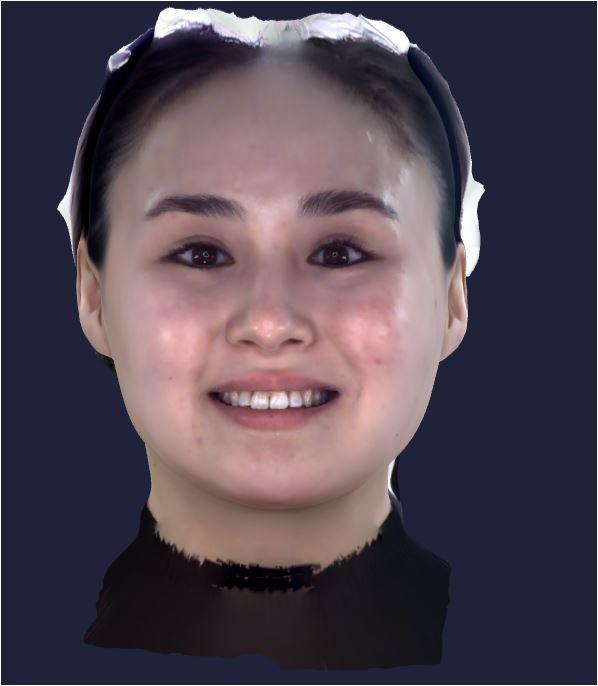 3D face scan merged with CBCT