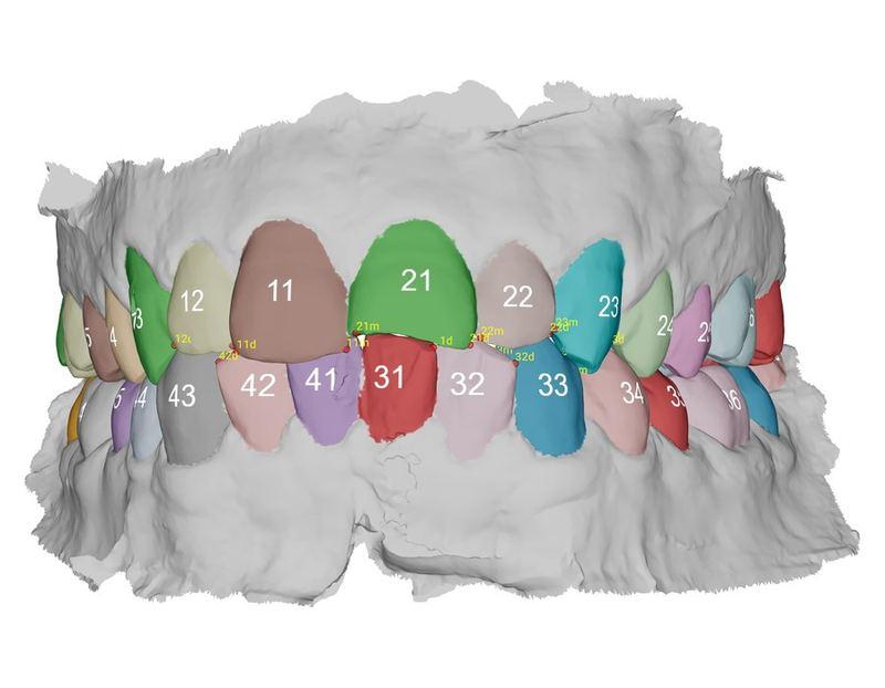 Intraoral scan analysis in Dentread AI Analytics