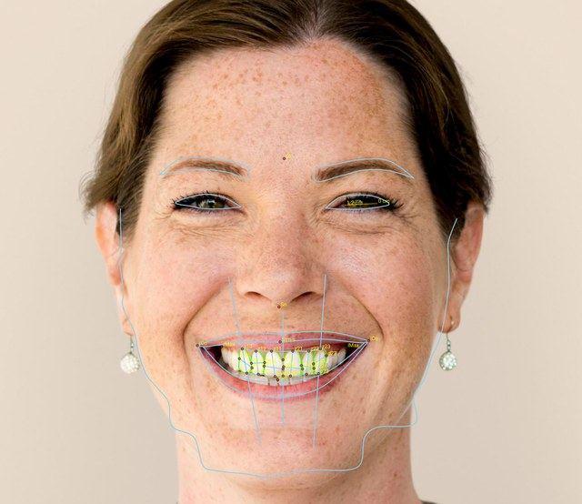 Lateral facial photo used for profile analysis