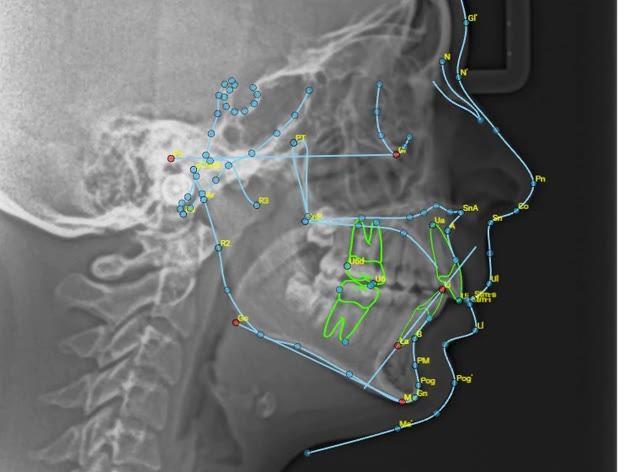 Video: AI ceph analysis on Dentread