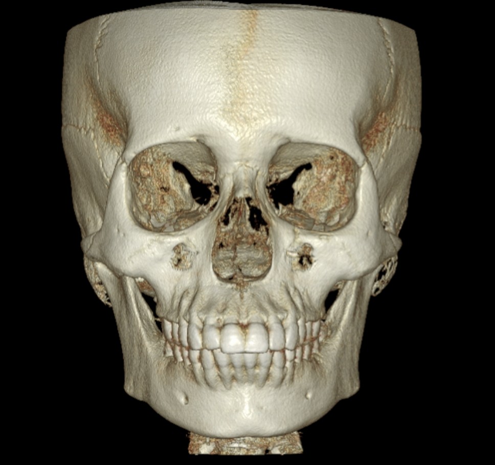 3D CBCT face rendering for TMJ and facial assessment