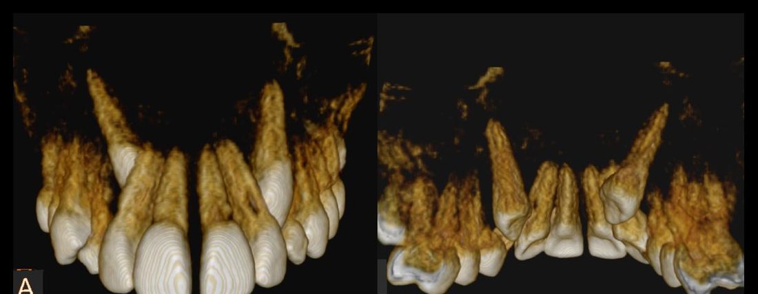 3D views of impacted and malpositioned teeth