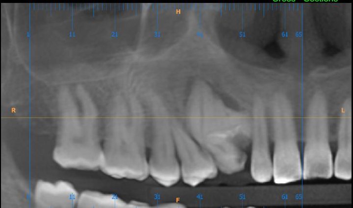 CBCT panoramic reconstruction