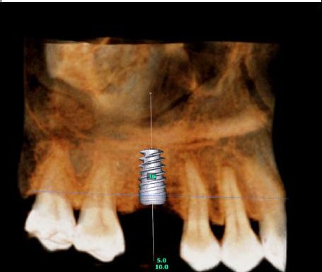 3D CBCT rendering with a virtual implant placed at 16